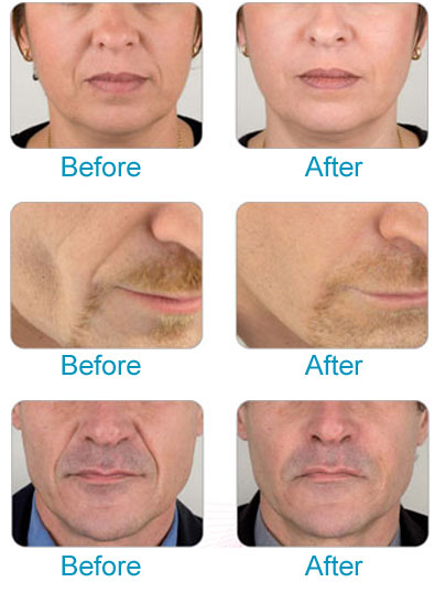 Dermal fillers from cosmetic dentist in Doncaster, Fountain Dental