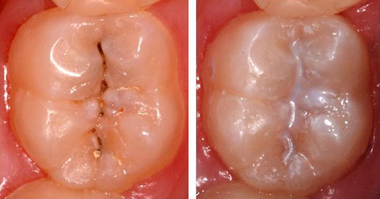 Fissure Sealant before and after