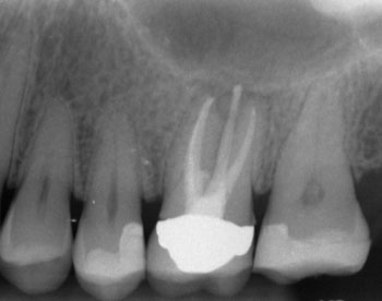 Completed root canal treatment